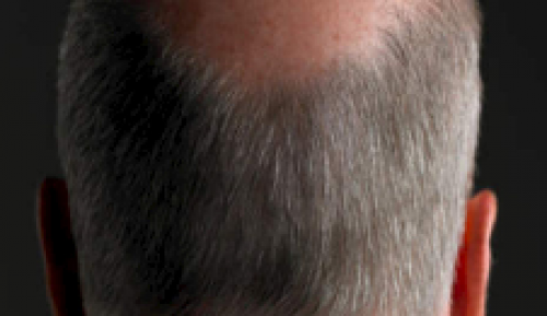 Wondermiddel tegen grijs haar en vitiligo?