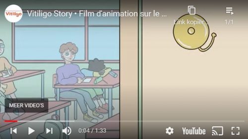 Vitiligo Story