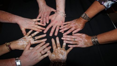 Wat is vitiligo en hoe ontstaat het?